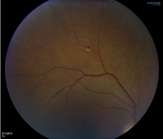 Veins Showing From Inside of an Eye