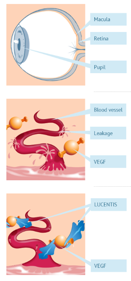 Diagram of an Eye and Blood Vessels in Eye